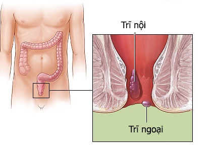 Gejala Penyakit Ambeien Dan Wasir